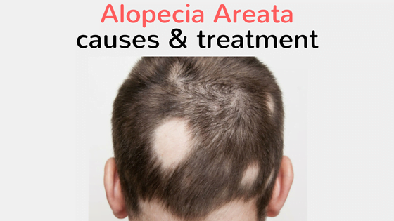 alopecia areata causes and treatment