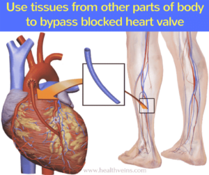 Angioplasty or bypass surgery which is better