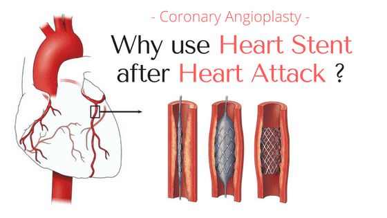 heart stent after heart attack