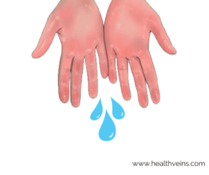 How to treat hyperhidrosis or excessive sweating