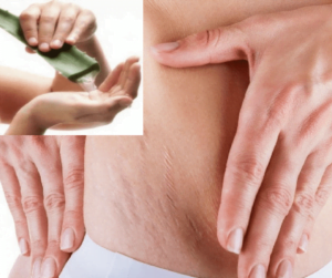 how to get rid of stretch marks fast and naturally