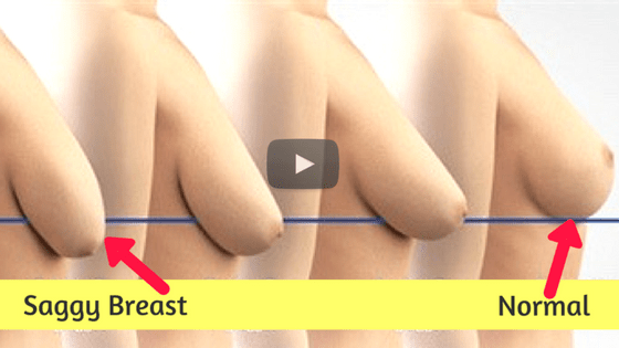 Top 5 Home Remedies To Make Sagging Breast Firm video